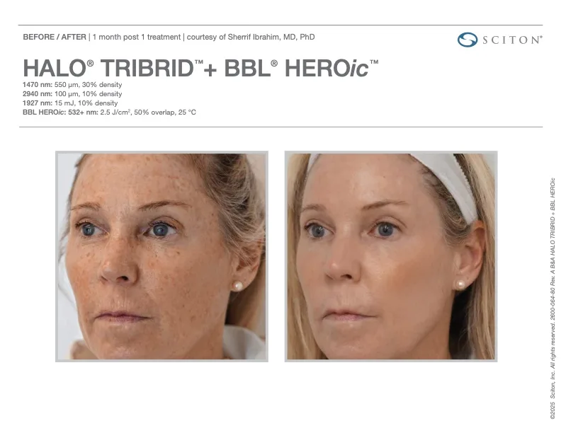 TRIBRID + BBL HEROic before and after - 1 month post treatment